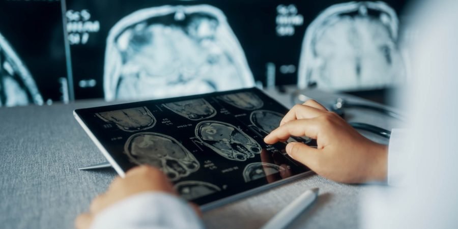 AVC em jovens cresce no Brasil e acende alerta entre especialistas